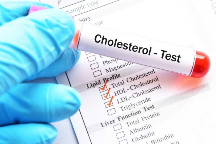 Dado que el colesterol total alto no presenta ningún síntoma, la única manera de saber si es alto es mediante una revisión médica y análisis clínicos.